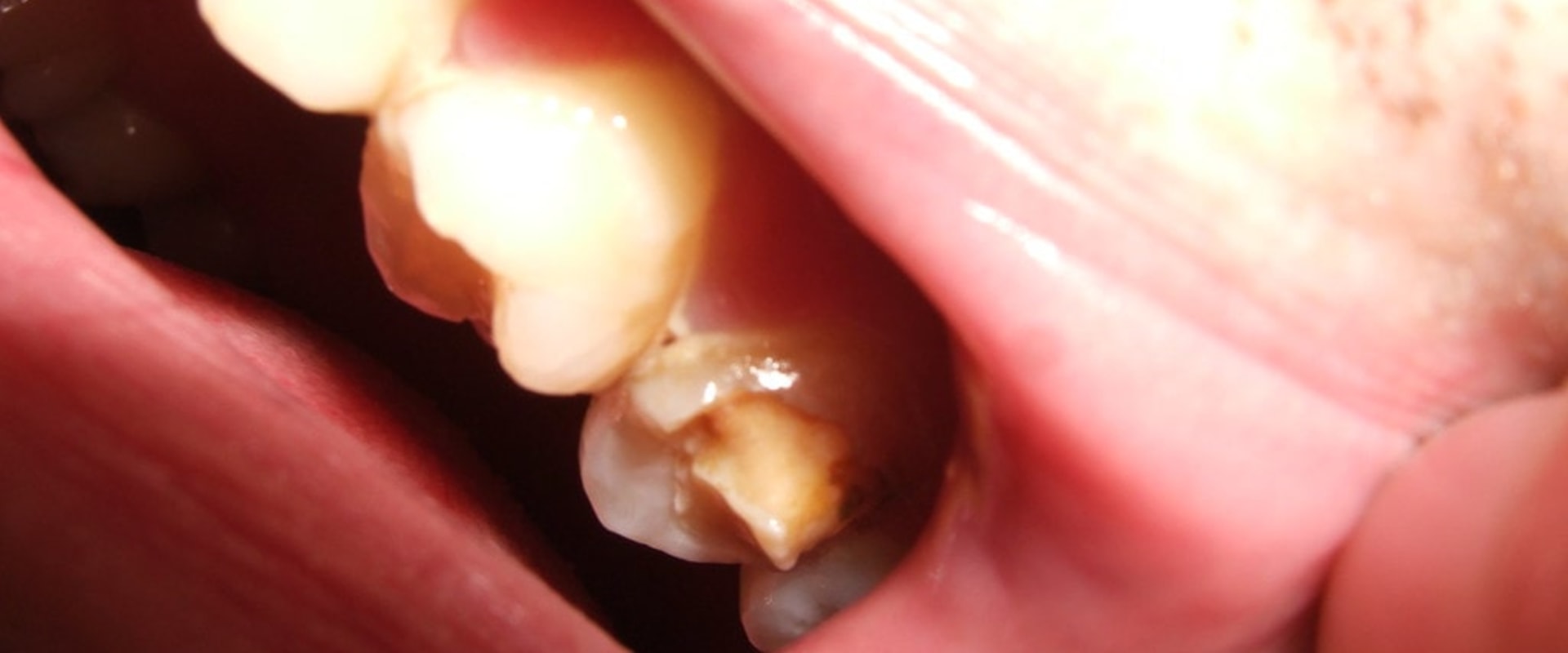 How to Prevent a Chipped Tooth from Getting Worse