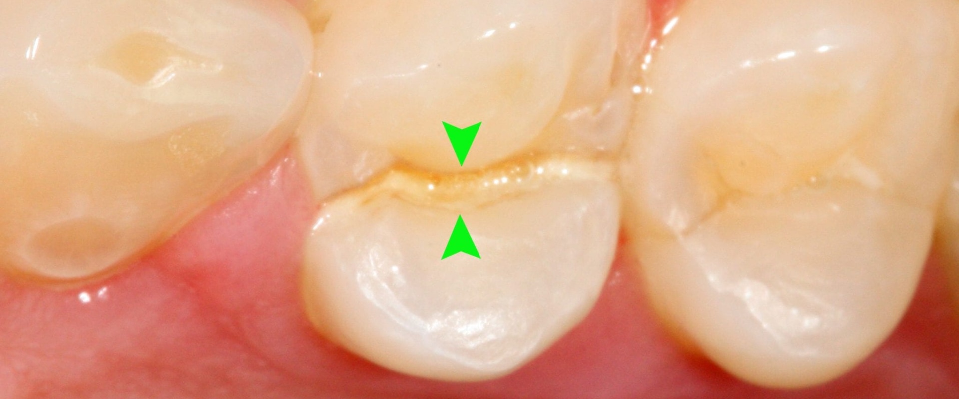 What Happens if You Leave a Chipped Tooth Untreated?