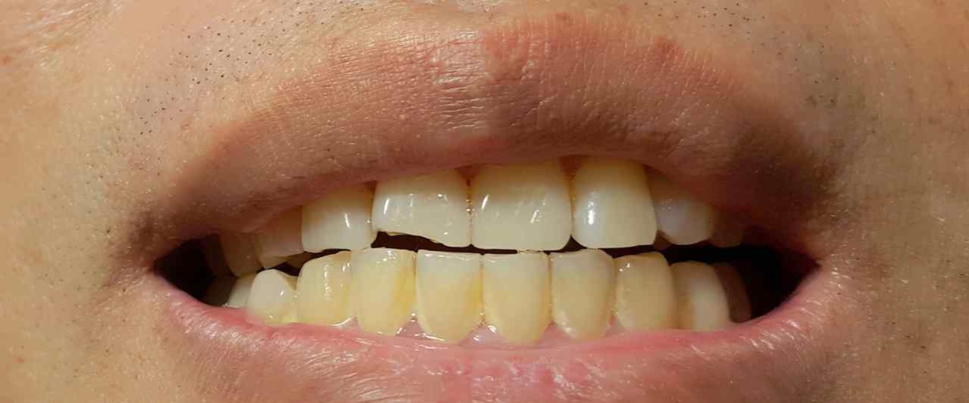 How Much Does it Cost to Fix a Chipped Tooth?
