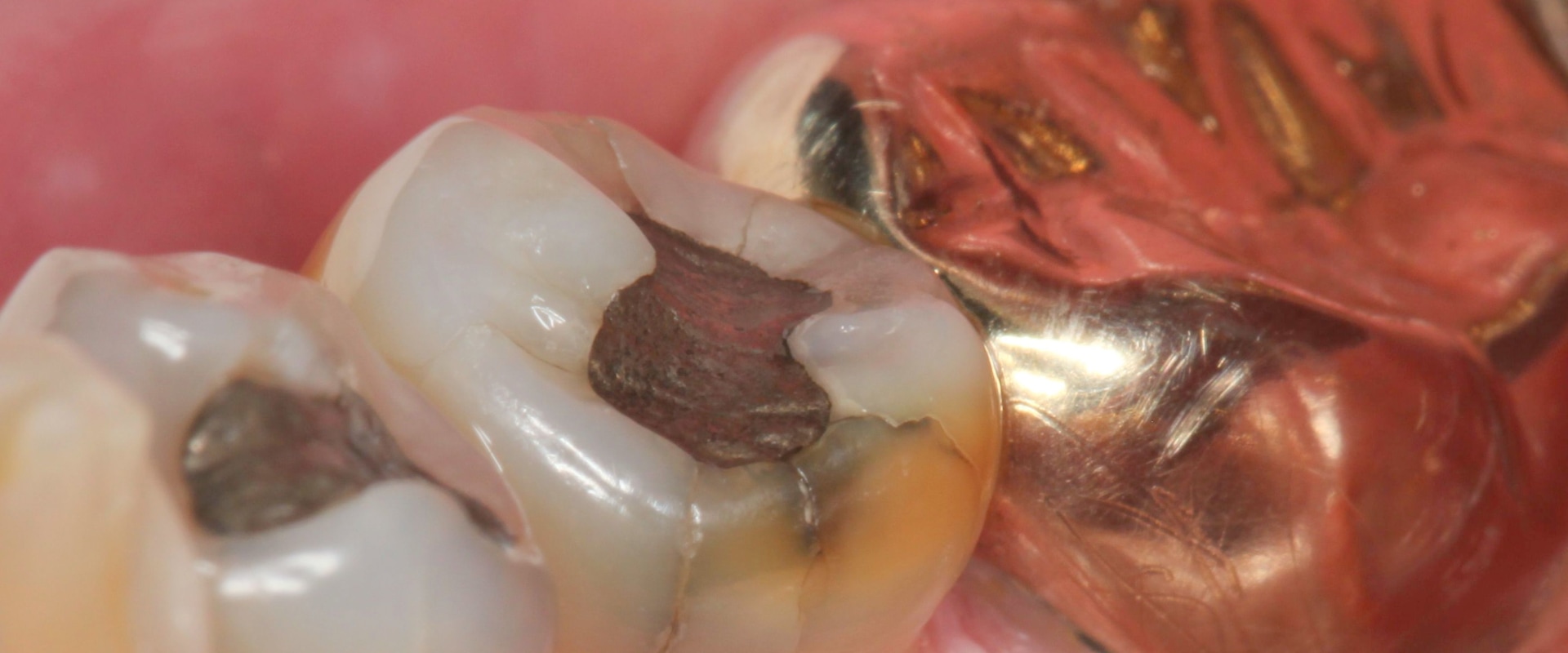 When Should You Seek Treatment for a Chipped Tooth?