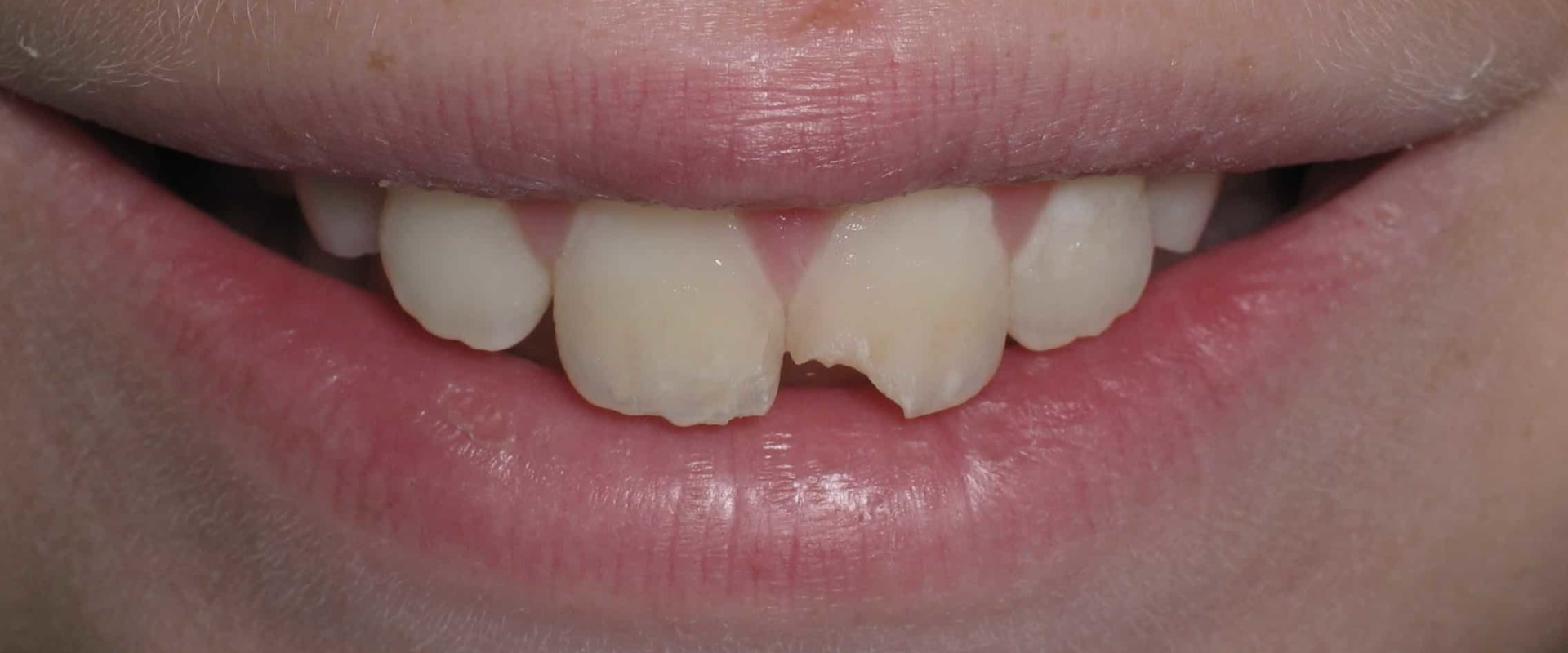 Can a Chipped Tooth Heal on Its Own?
