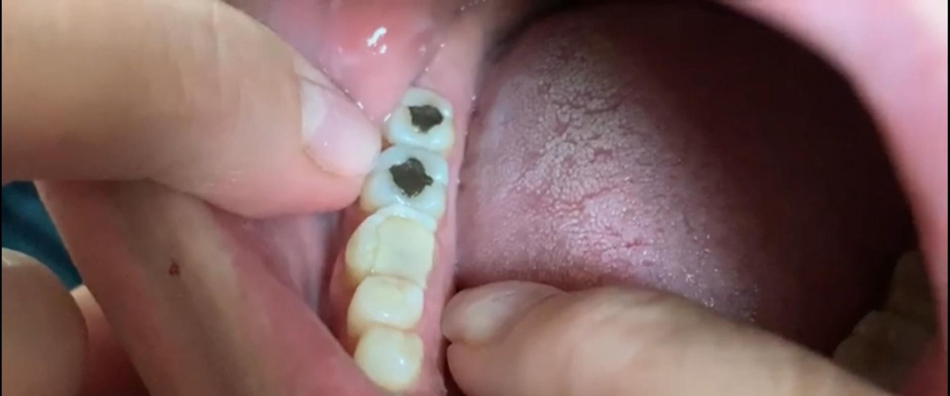 Can I File a Chipped Tooth Myself? Expert Advice on How to Handle It