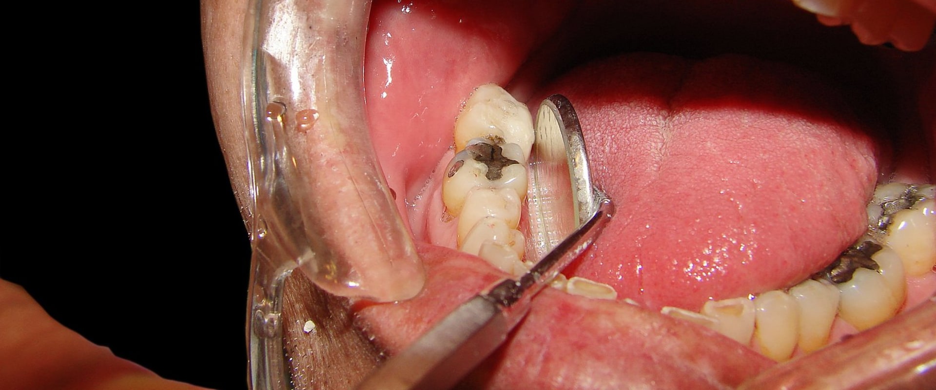 Can a Chipped Tooth Be Left Alone? - Expert Advice