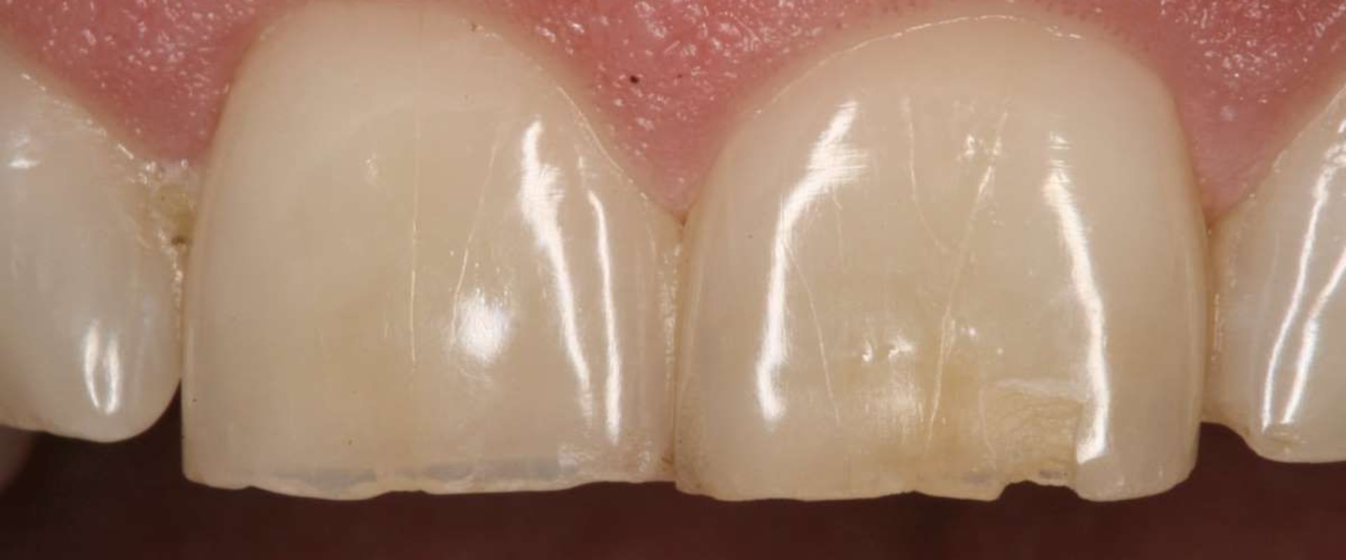 When Should You See a Dentist for a Chipped Tooth?