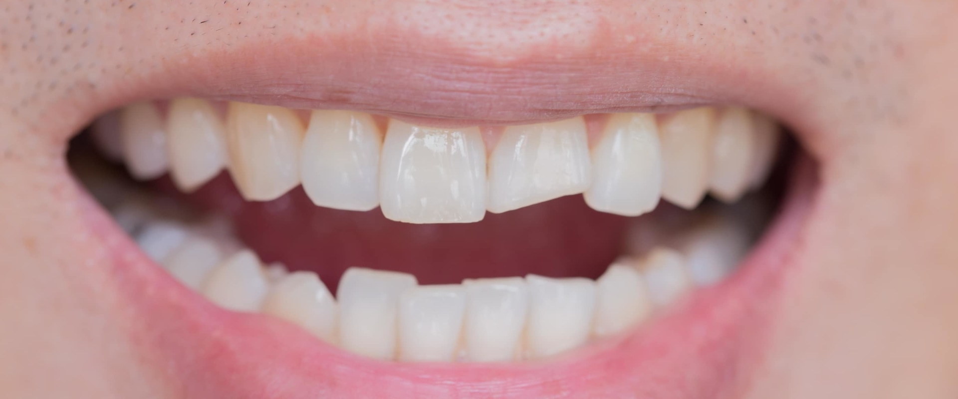 Is it Worth Getting a Chipped Tooth Fixed?