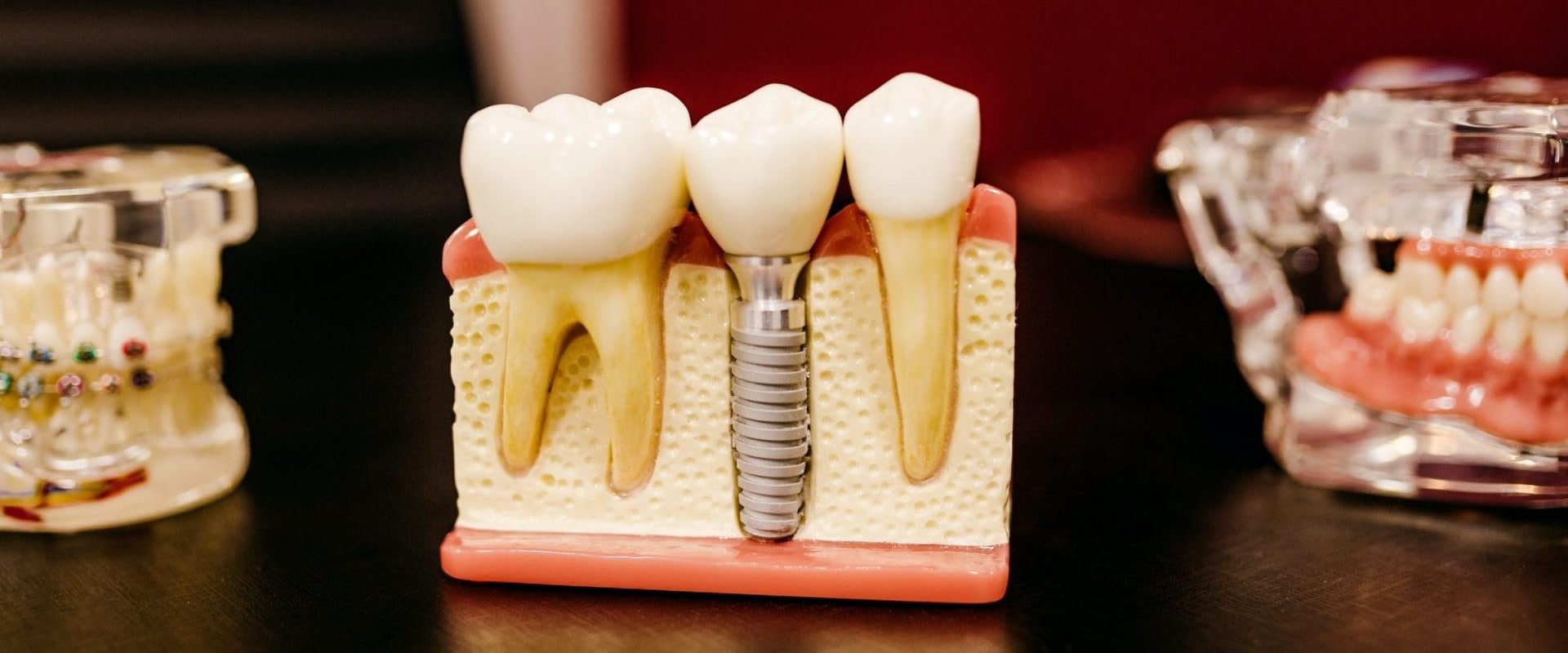 How to Permanently Fix a Chipped Tooth at Home