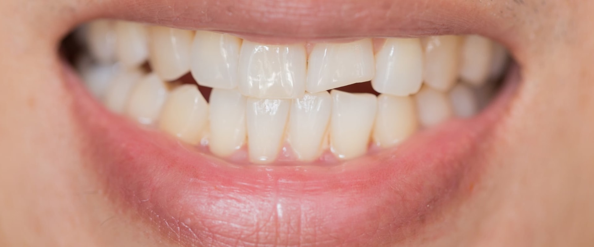 Does a Chipped Tooth Need Immediate Attention?