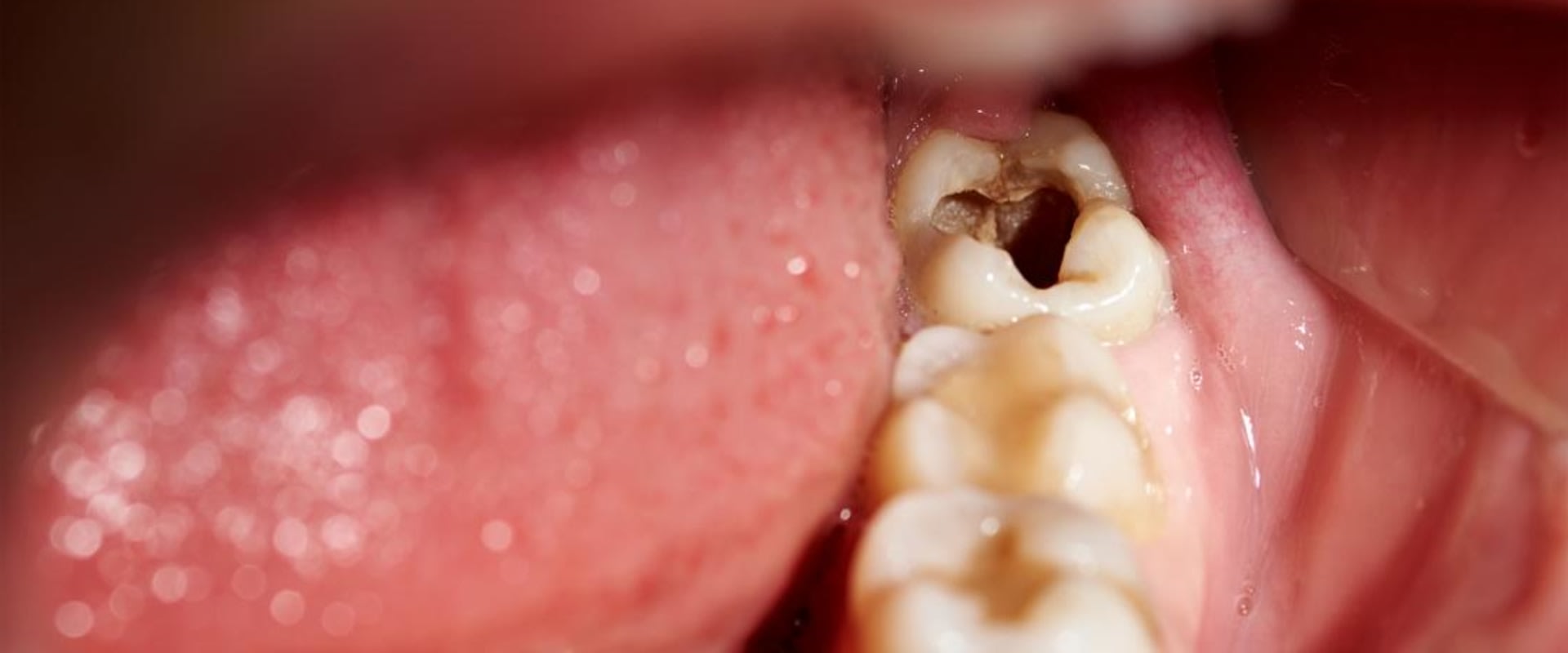 What Happens When You Have a Chipped Tooth?