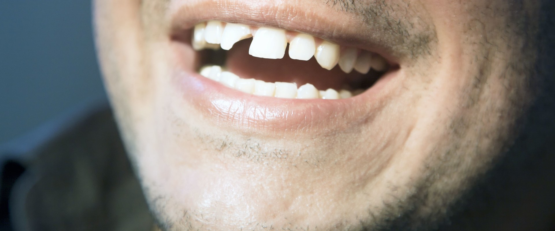Can a Dentist Fix a Chipped Tooth in One Day?