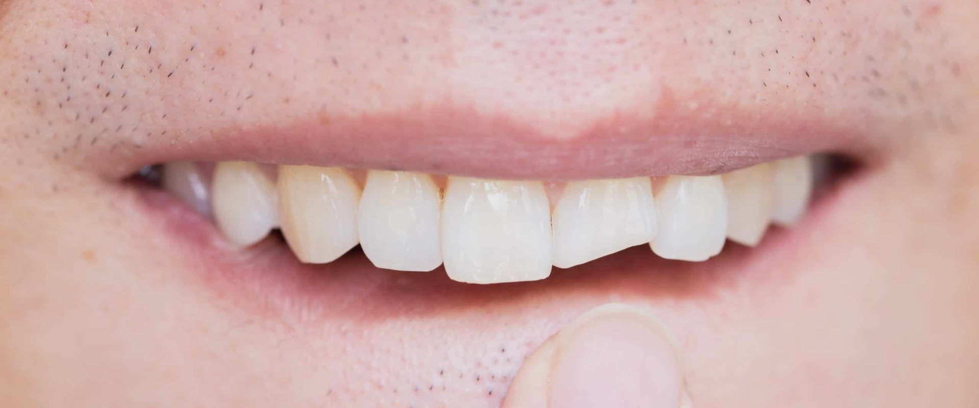 How to Repair a Chipped Tooth and Avoid Further Damage