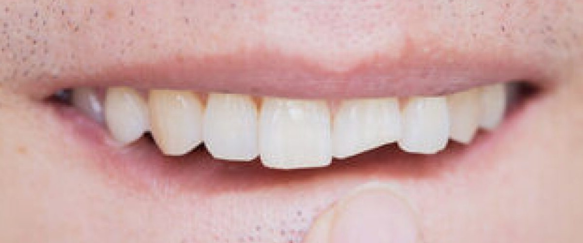 How to Repair Chip in The Teeth: A Comprehensive Guide
