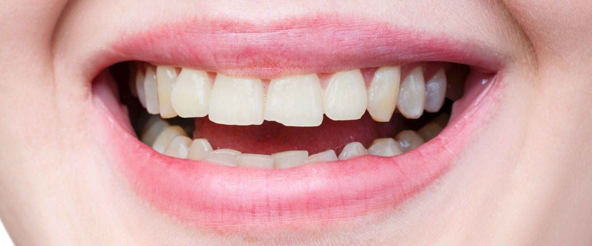 Permanent Solutions for Chipped Teeth