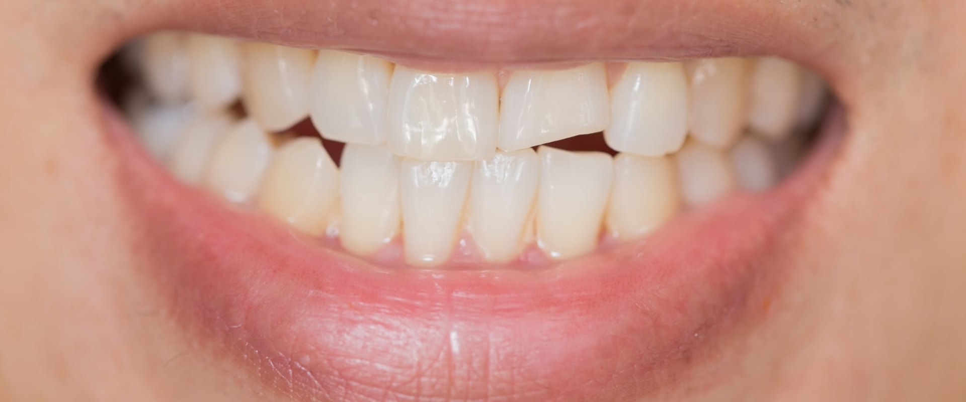 How Long Does It Take for a Chipped Tooth to Heal?