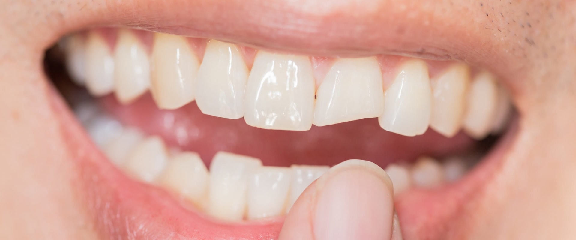 Can I Leave a Chipped Tooth Alone?