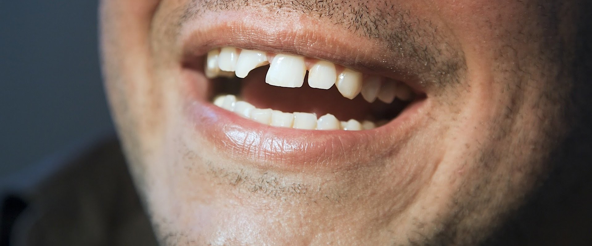Is a Chipped Tooth Serious? Expert Advice on Treatment and Prevention