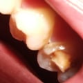 How to Prevent a Chipped Tooth from Getting Worse