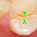 What Happens if You Leave a Chipped Tooth Untreated?