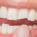 What to Do When You Have a Chipped Tooth