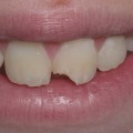 How Long Does a Tooth Chip Repair Last?