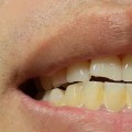 How Much Does it Cost to Fix a Chipped Tooth?