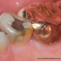 When Should You Seek Treatment for a Chipped Tooth?
