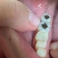 Can I File a Chipped Tooth Myself? Expert Advice on How to Handle It