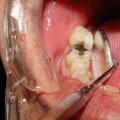 Can a Chipped Tooth Be Left Alone? - Expert Advice