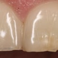 When Should You See a Dentist for a Chipped Tooth?