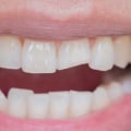 Is it Worth Getting a Chipped Tooth Fixed?