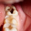 What Happens When You Have a Chipped Tooth?