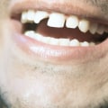 Can a Dentist Fix a Chipped Tooth in One Day?
