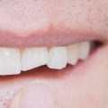How to Repair a Chipped Tooth and Avoid Further Damage