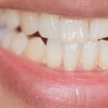 Do I Need to Fix a Chipped Tooth?