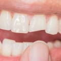 Can I Leave a Chipped Tooth Alone?