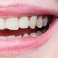 Can a Chipped Tooth be Permanently Fixed?