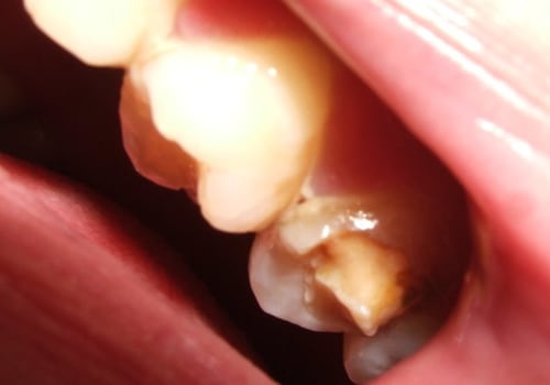 How to Prevent a Chipped Tooth from Getting Worse