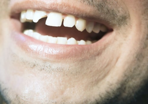 How Much Does it Cost to Repair a Chipped Tooth?