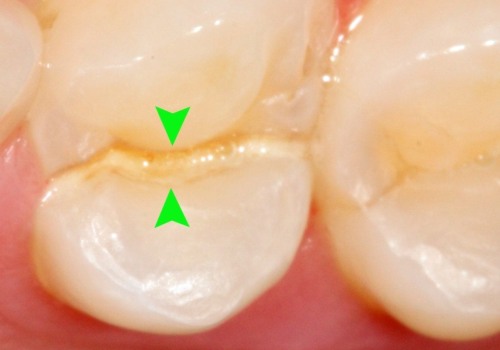 What Happens if You Leave a Chipped Tooth Untreated?