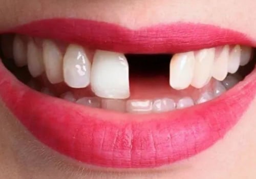 Can a Chipped Tooth Regrow? - Expert Advice on How to Restore It