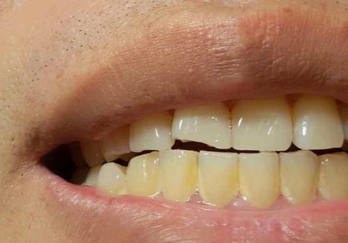 How Much Does it Cost to Fix a Chipped Tooth?