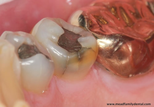 When Should You Seek Treatment for a Chipped Tooth?