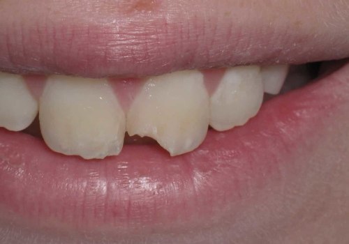 Can a Chipped Tooth Heal on Its Own?