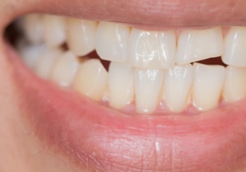 What Are the Consequences of Not Treating a Chipped Tooth?