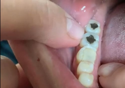 Can I File a Chipped Tooth Myself? Expert Advice on How to Handle It