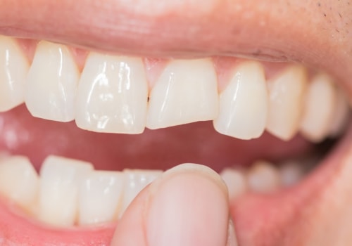 How Long Does It Take for a Chipped Tooth to Become Infected?
