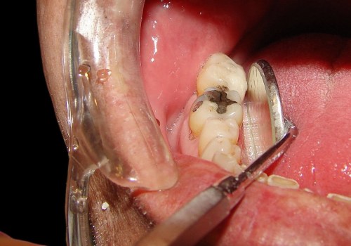 Can a Chipped Tooth Be Left Alone? - Expert Advice