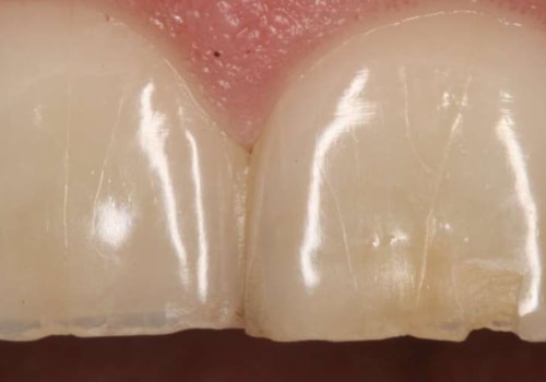 When Should You See a Dentist for a Chipped Tooth?