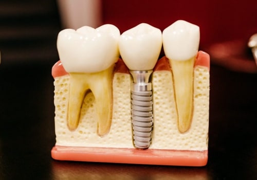 How to Permanently Fix a Chipped Tooth at Home