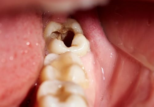 What Happens When You Have a Chipped Tooth?