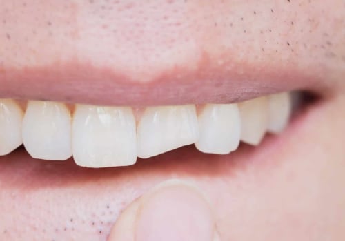 How to Repair a Chipped Tooth and Avoid Further Damage